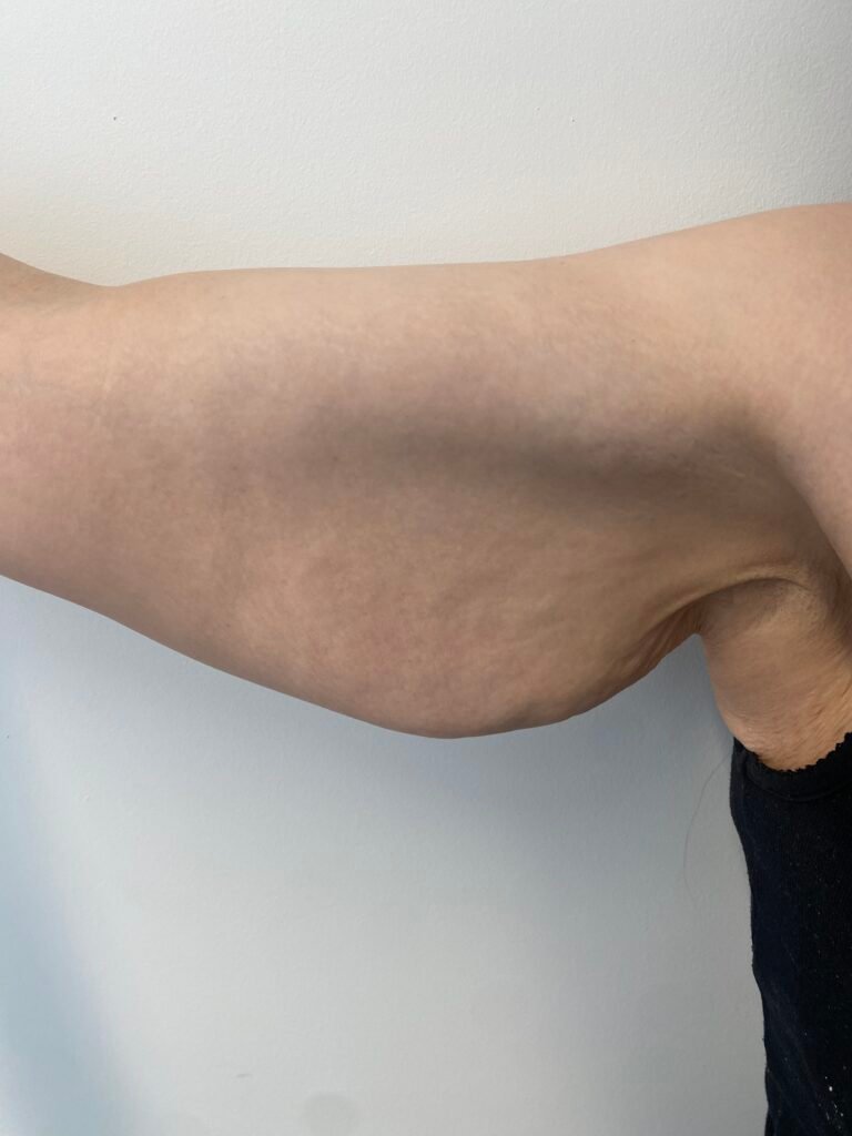 body contour arm lift