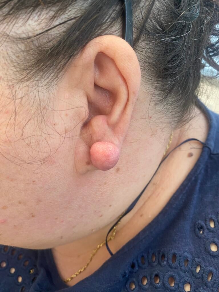 body contour keloid