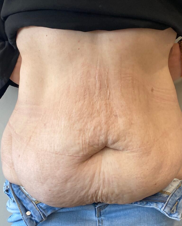 Tummy Tuck A1