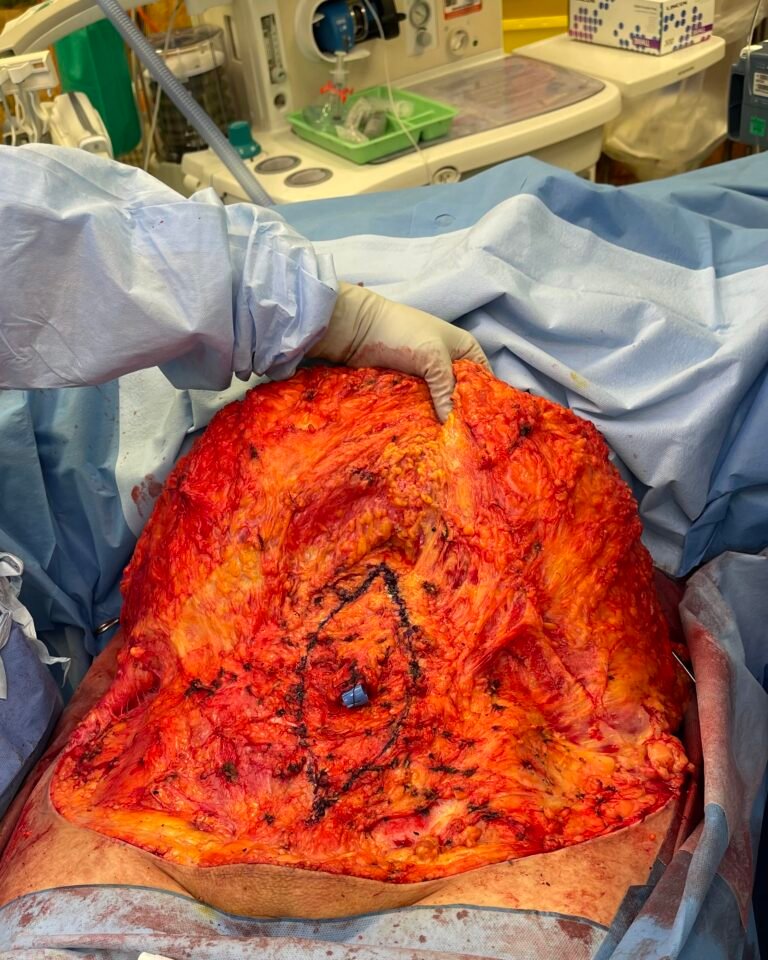 Tummy Tuck A5