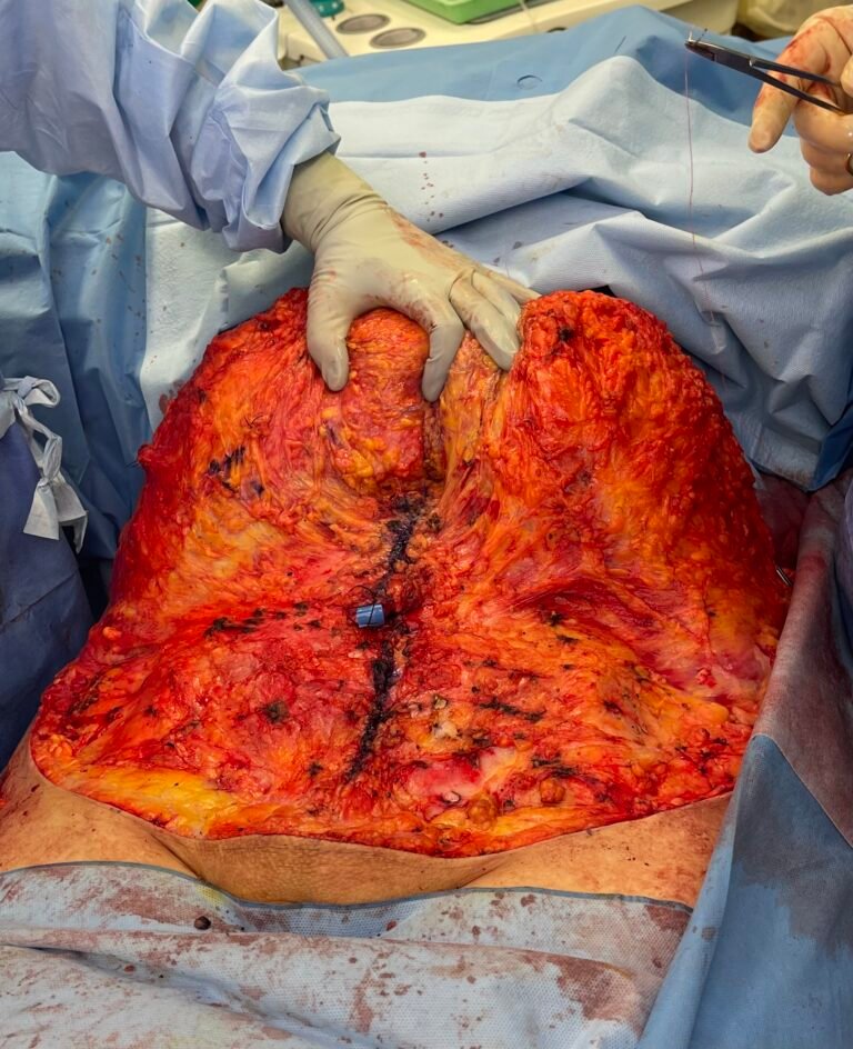 Tummy Tuck A6