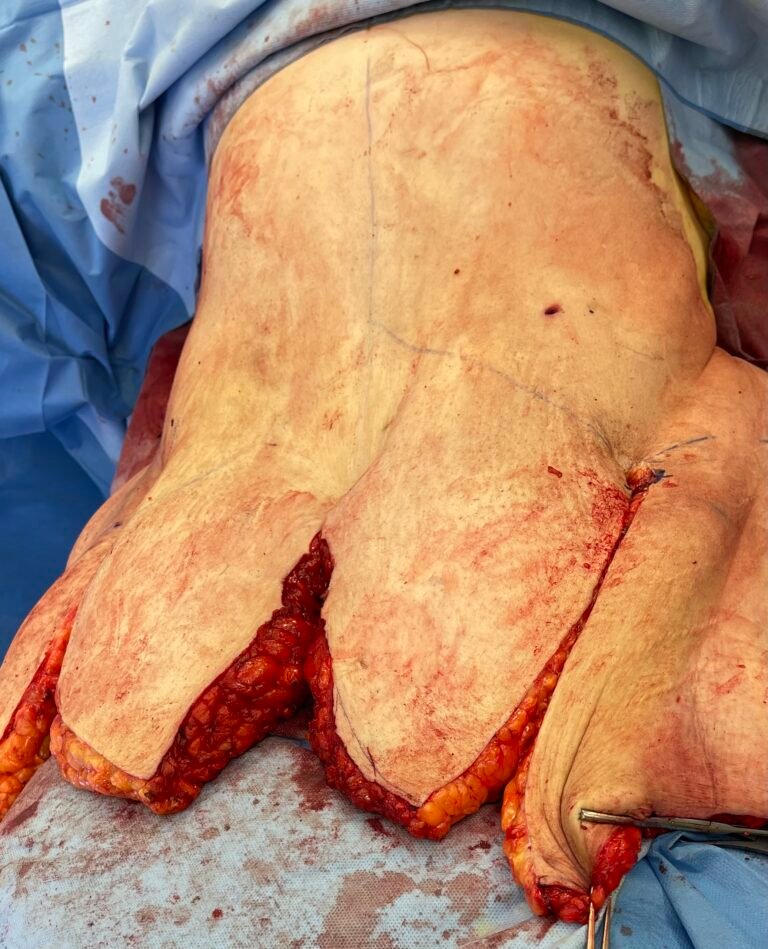 Tummy Tuck A7