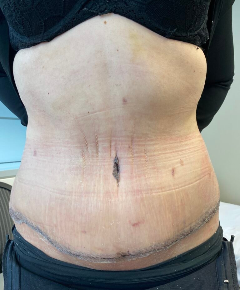 Tummy Tuck A10