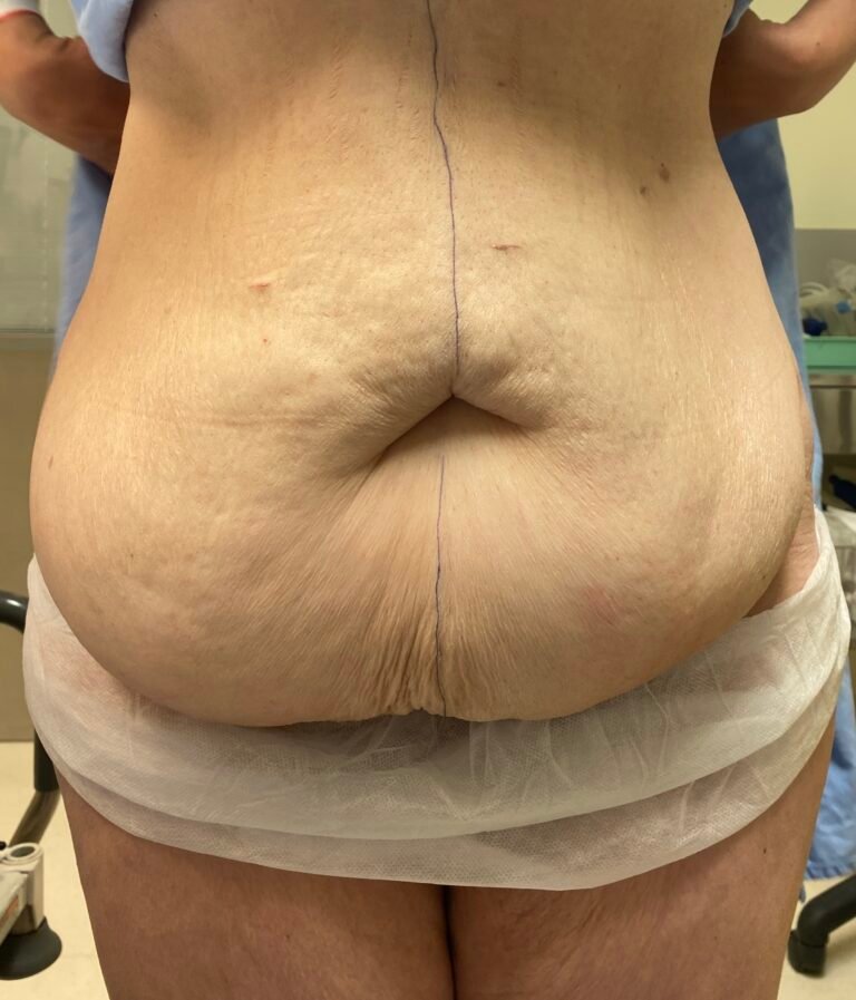 Tummy Tuck A3