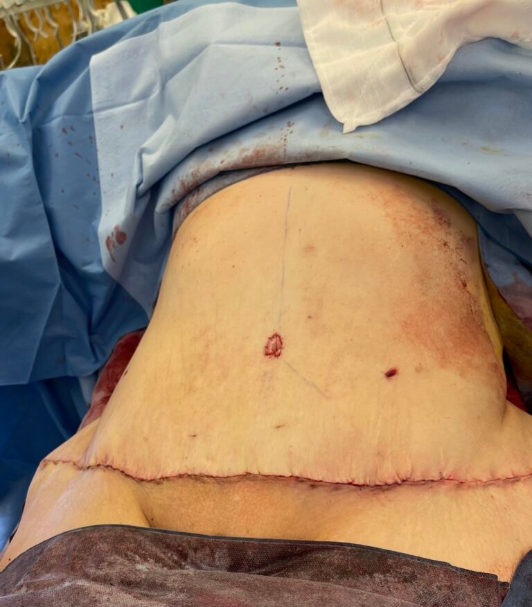 Tummy Tuck A8