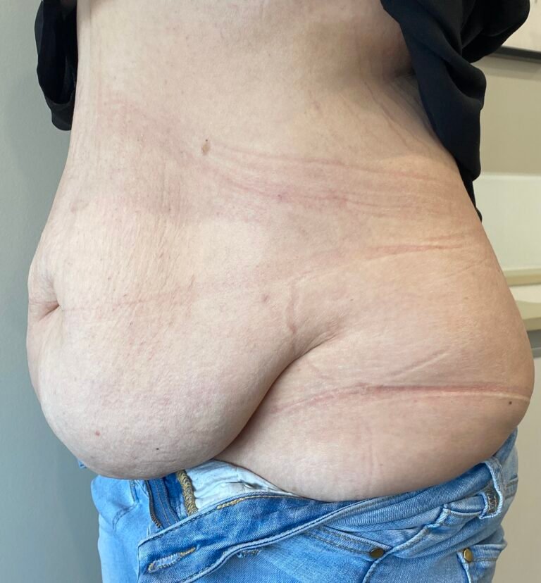 Tummy Tuck A2