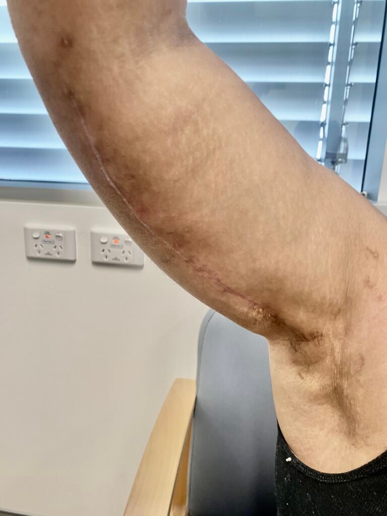 arm lift A14