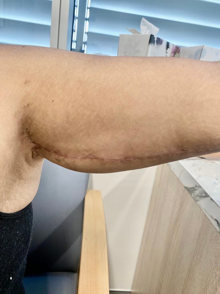 arm lift A13