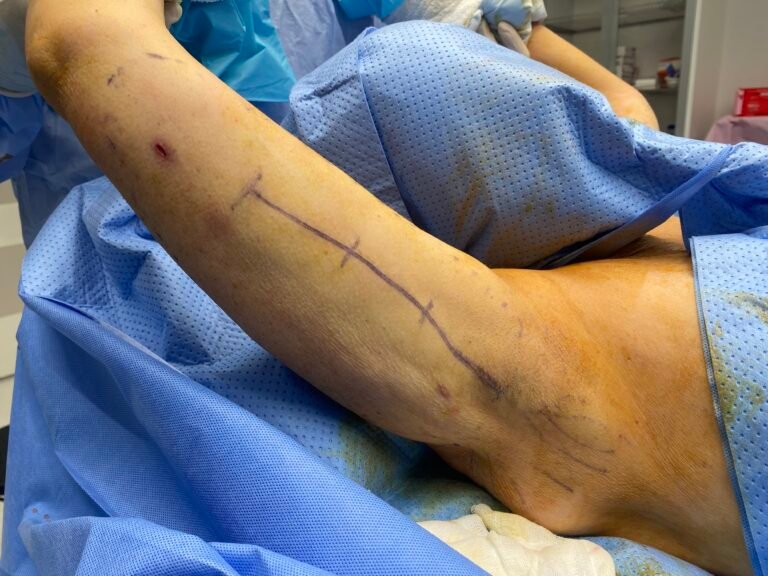 Arm lift after liposuction C2