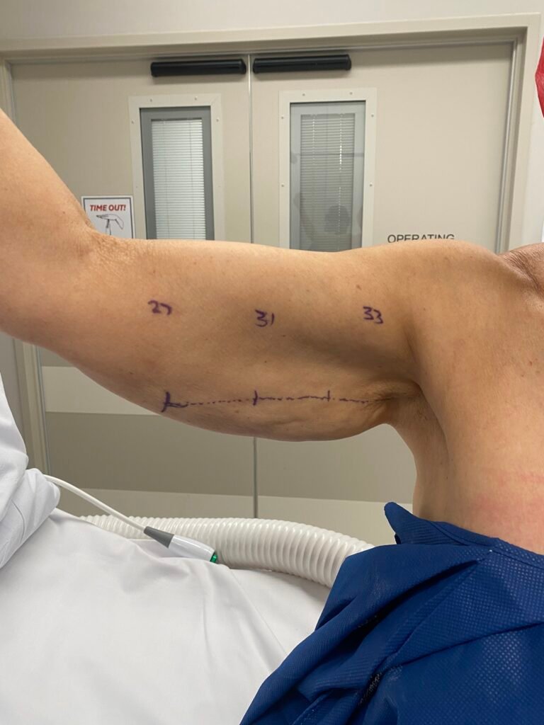 Arm lift before surgery C 1