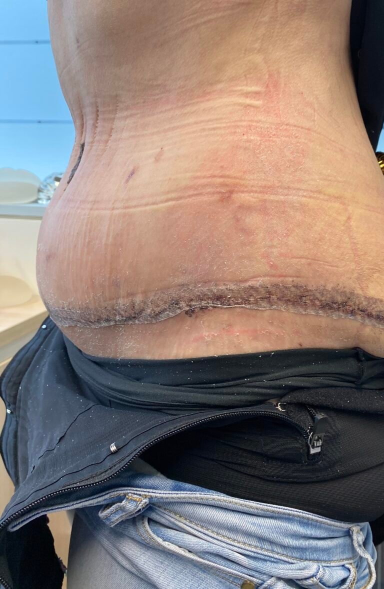 Tummy Tuck A9