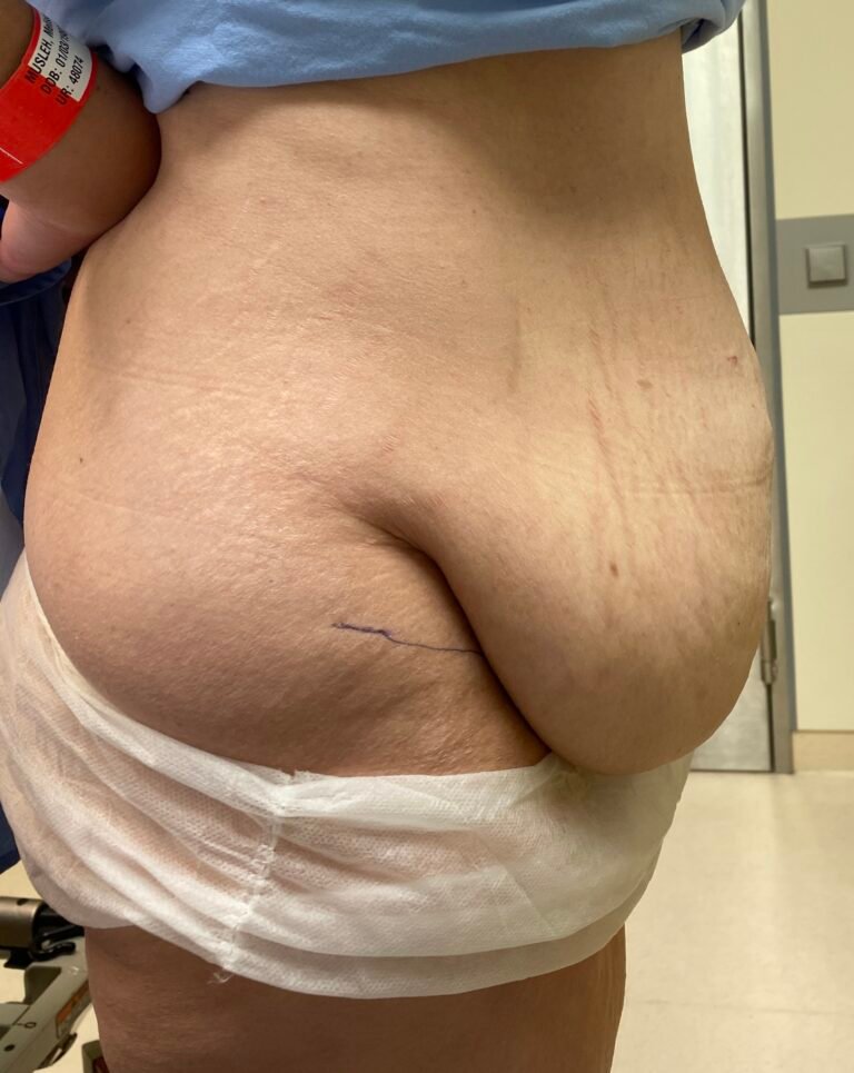 Tummy Tuck A4