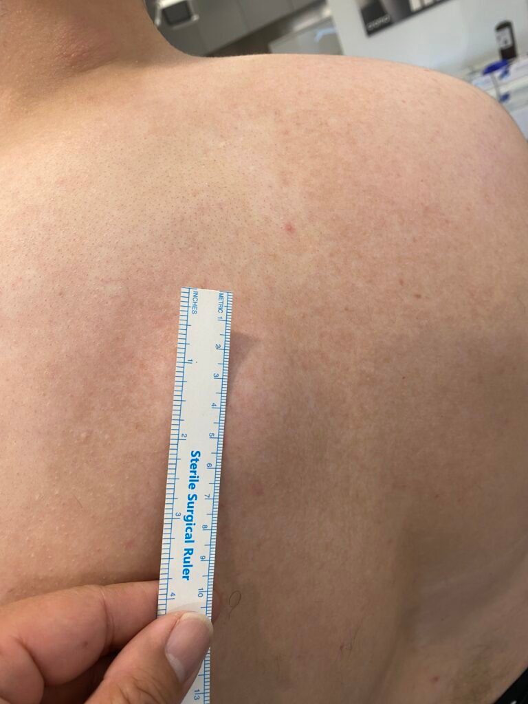 lipoma back