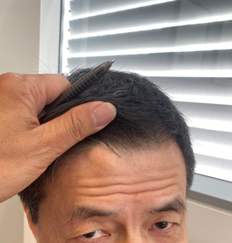 body contour lipoma left forehead