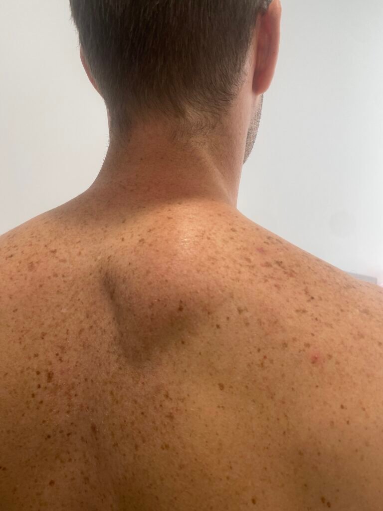 body contour large lipoma back