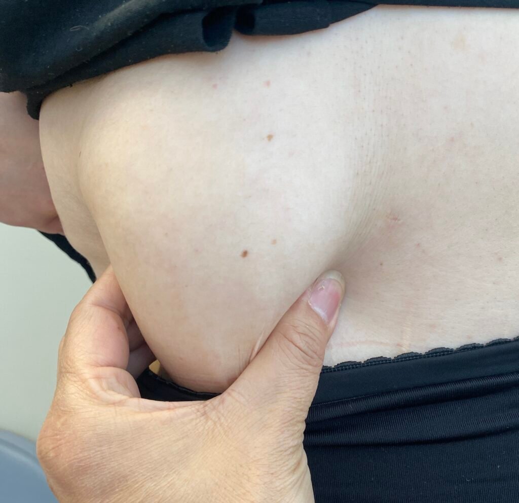 body contour large lipoma abdomen