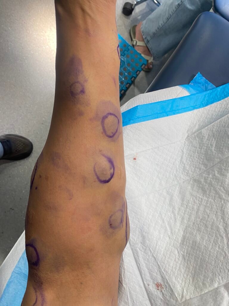 lipoma arm dercum syndrome