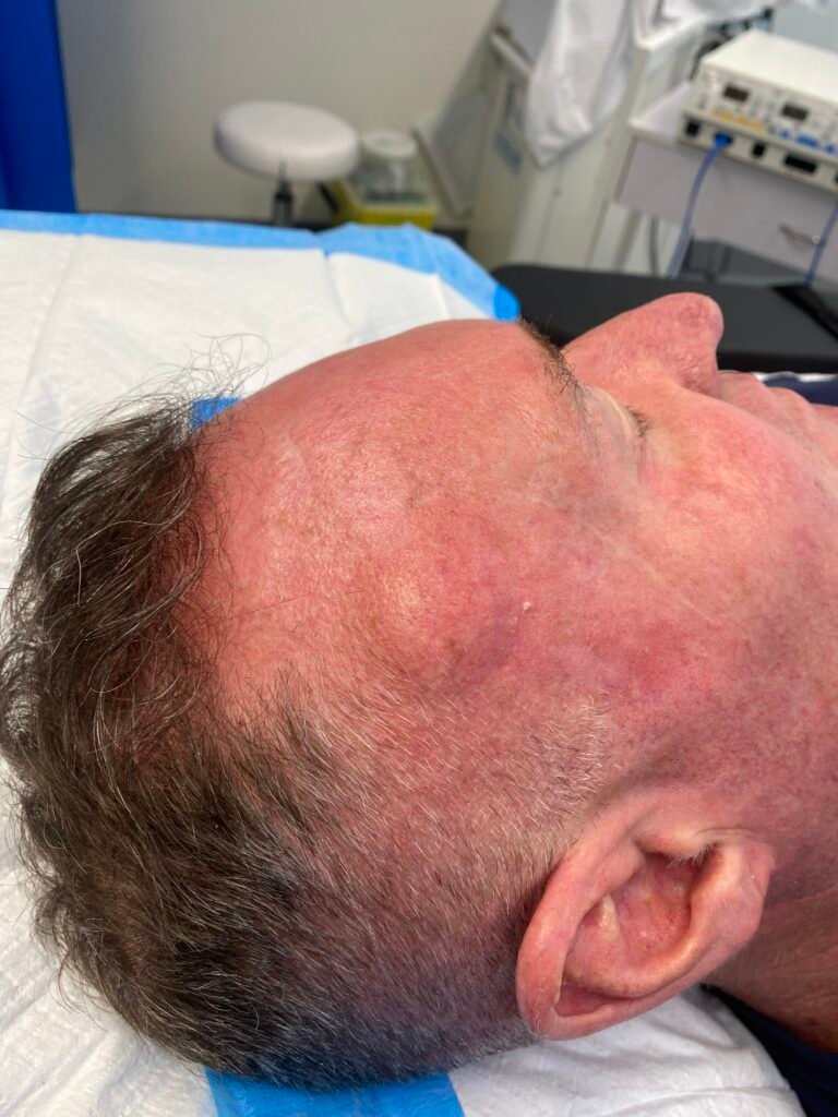 body contour lipoma temporal