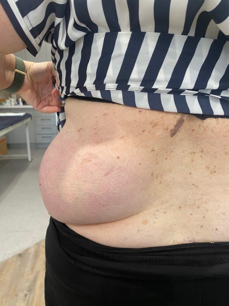 lipoma left abdomen