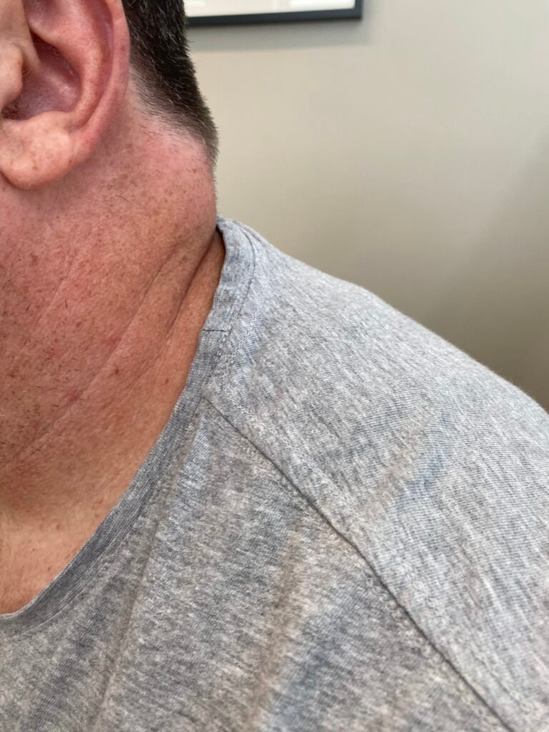 lipoma neck body contour
