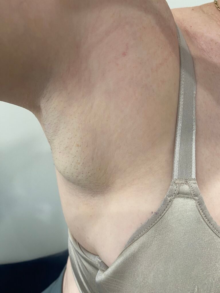 lipoma axilla