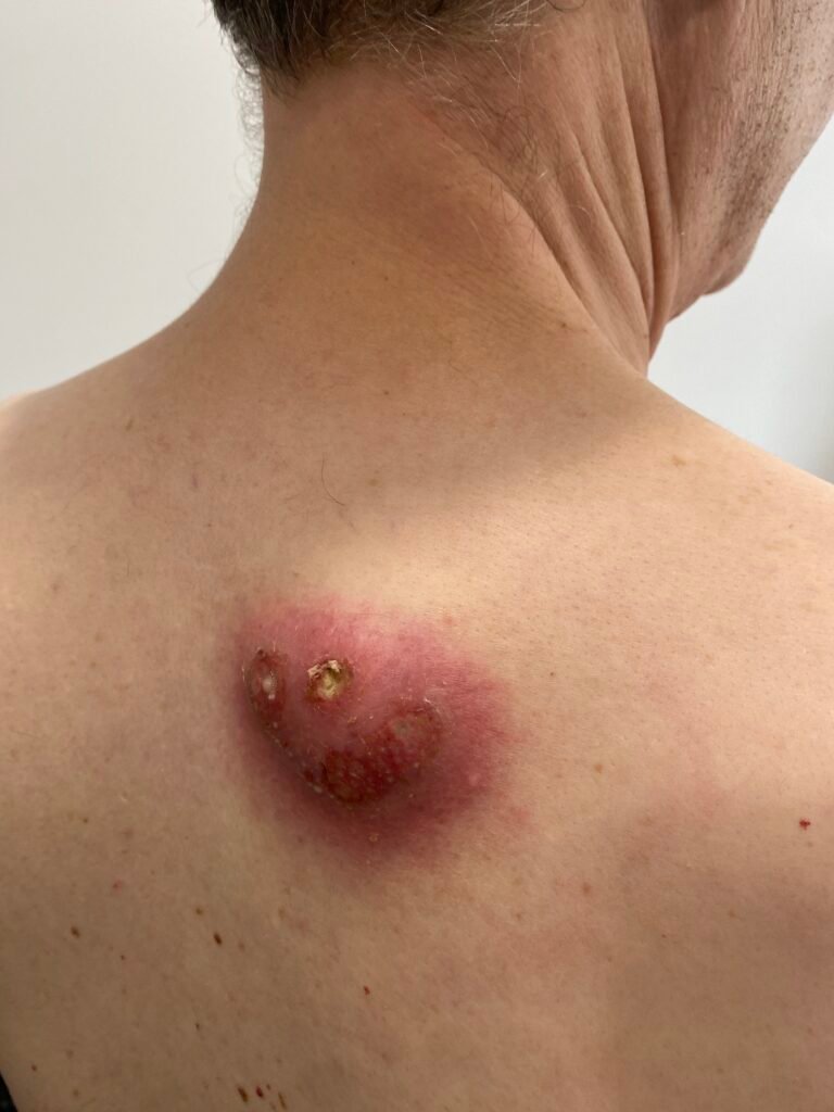 infected cyst on the back