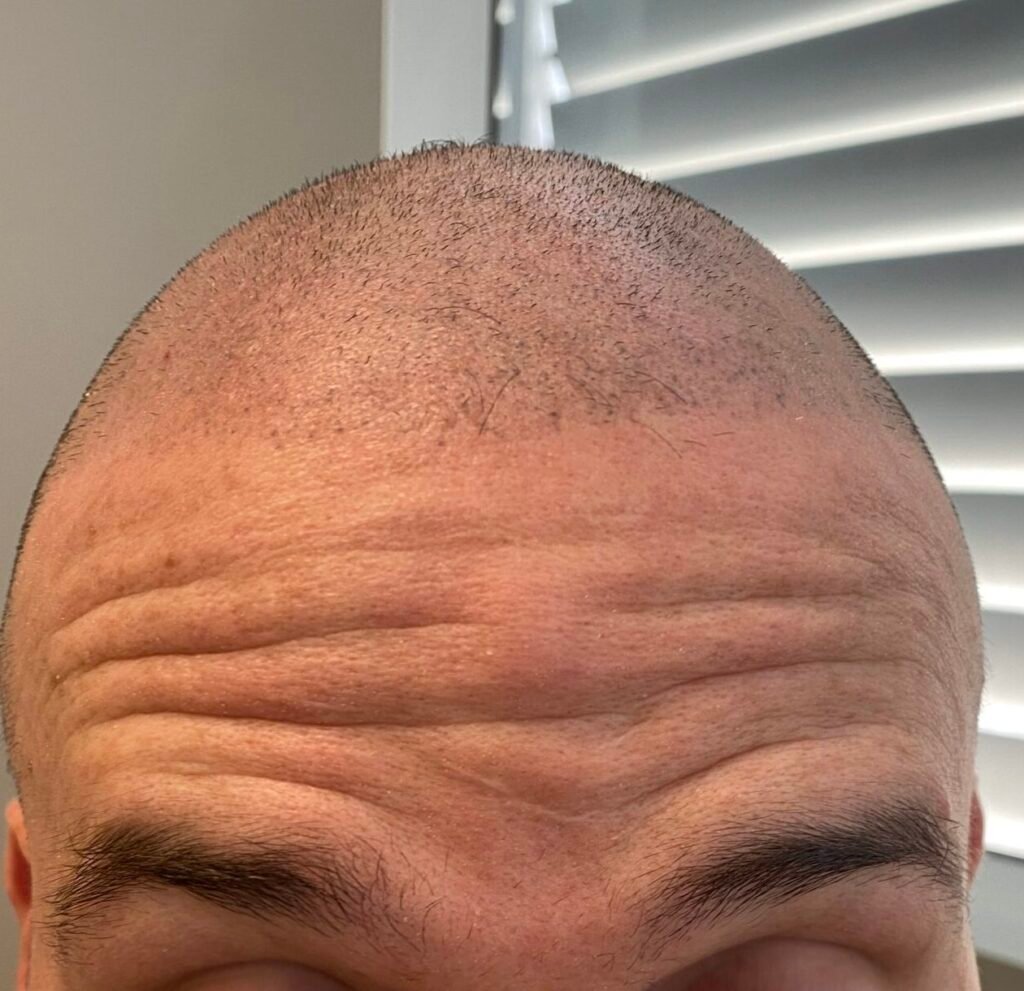 body contour lipoma forehead