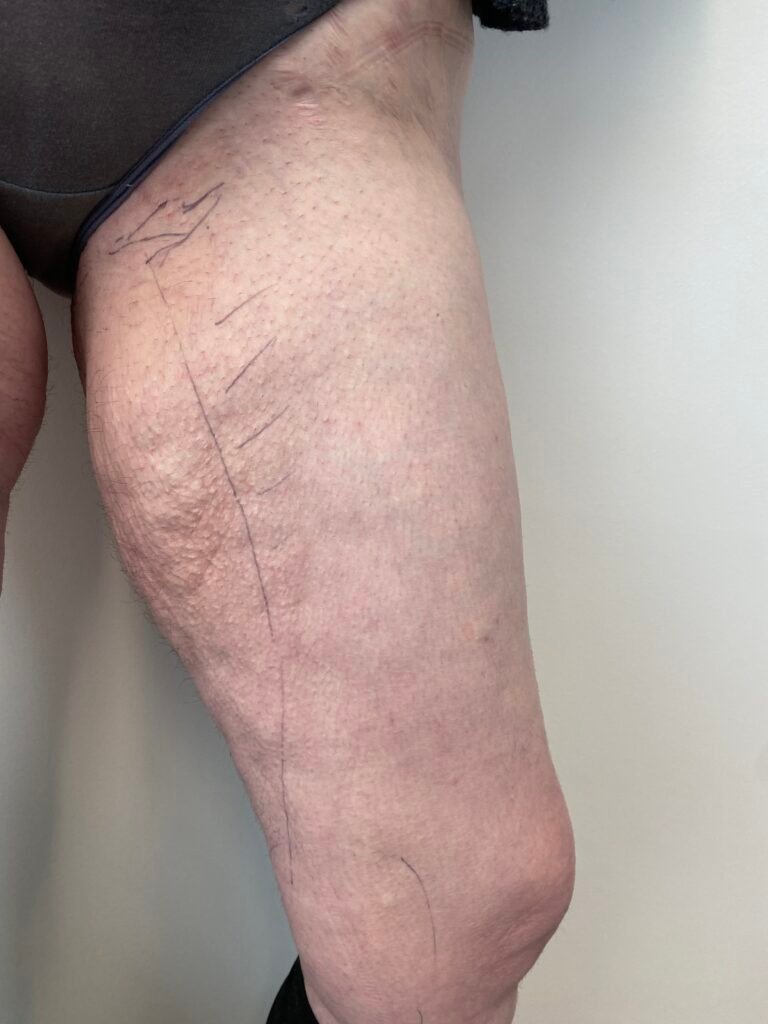 Thigh lift A1