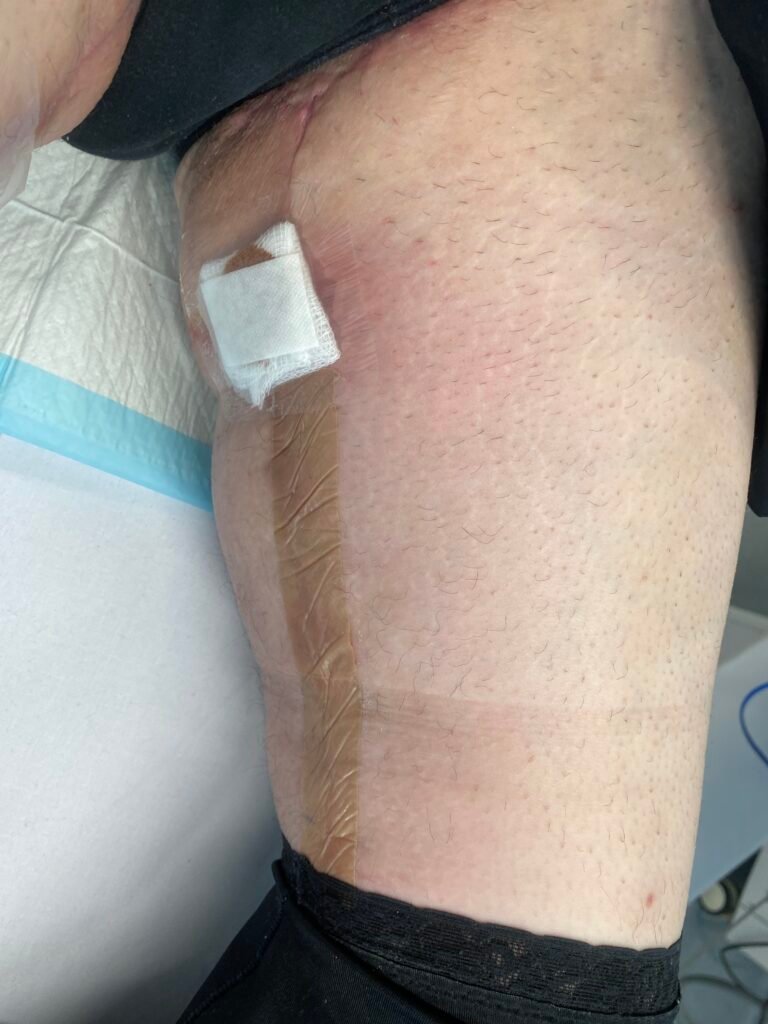 Thigh lift A12