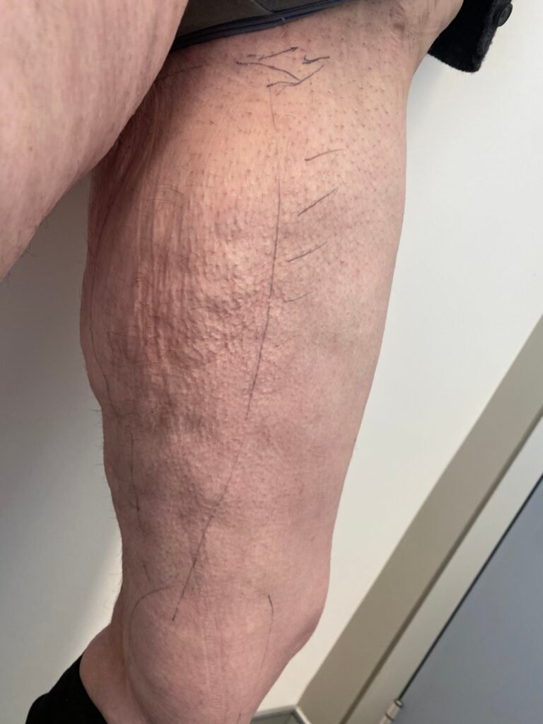 Thigh lift A2
