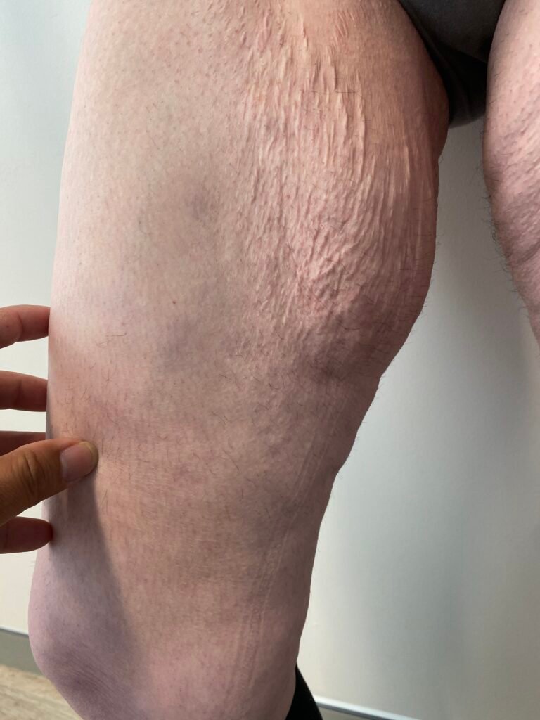 Thigh lift A2