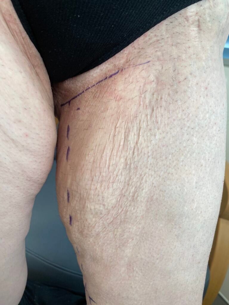 Thigh lift A4