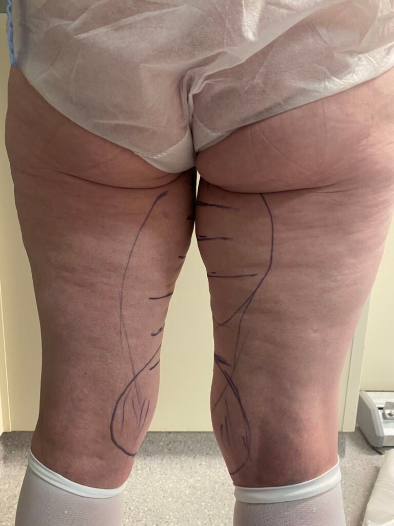 Thigh lift A6