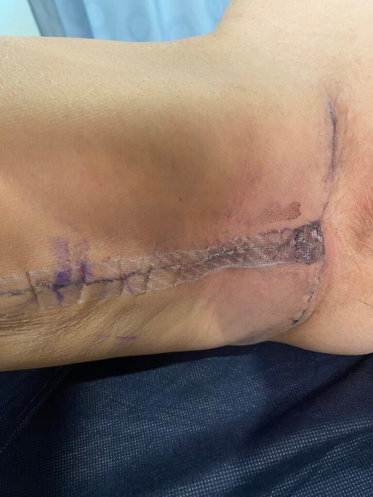 Thigh lift after surgery 2 week