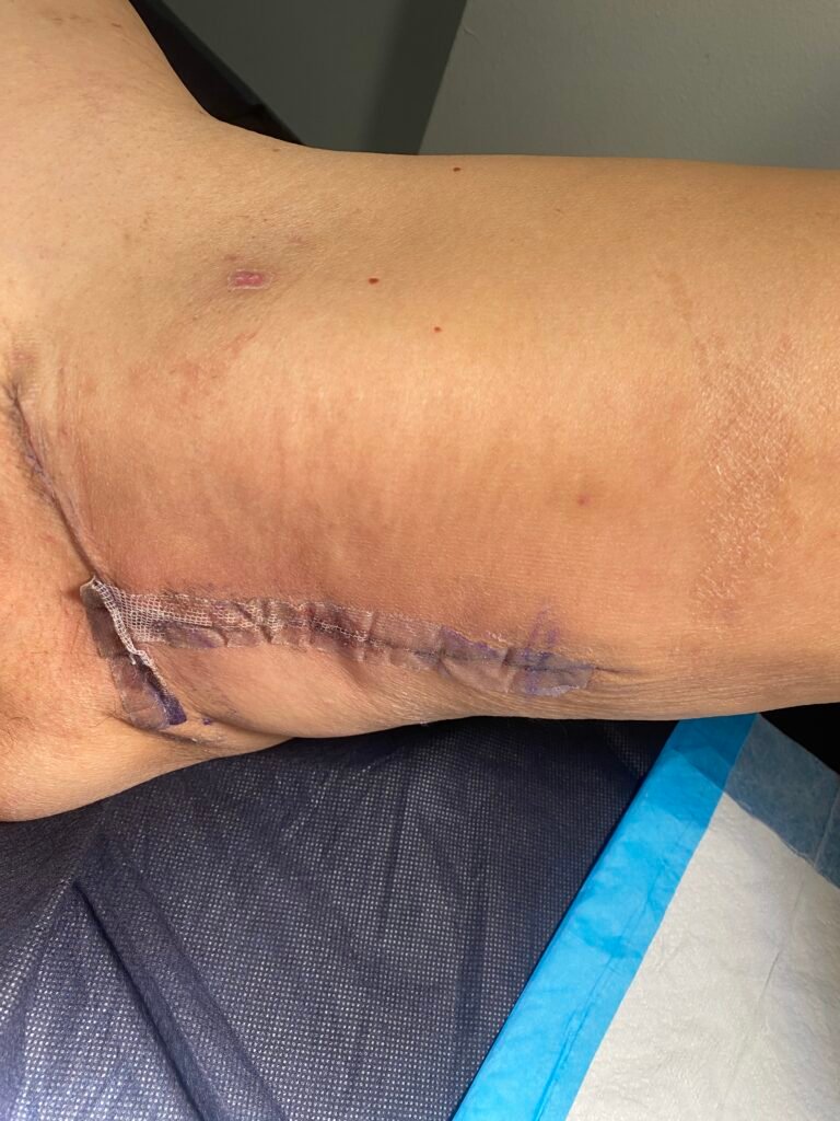 Thigh lift after surgery 2 week a