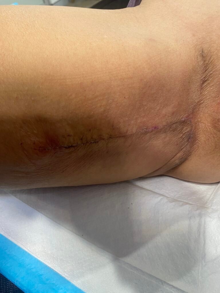 Thigh lift after surgery 4 week a