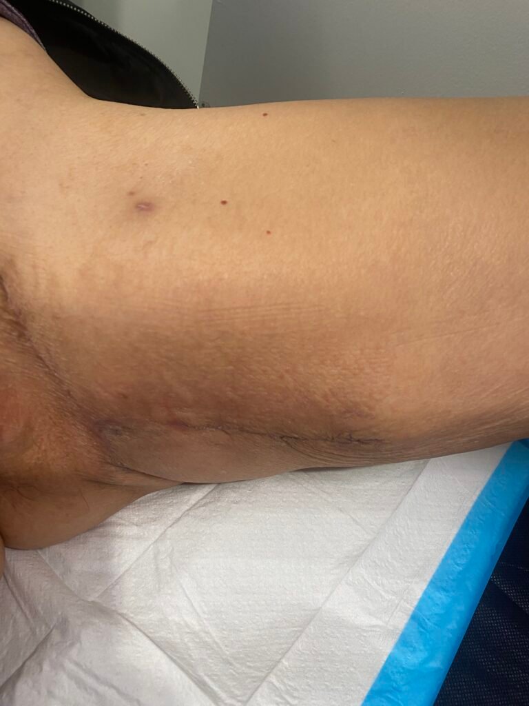 Thigh lift after surgery