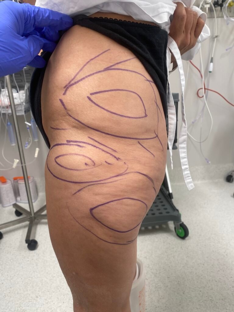 Thigh lift before surgery 1