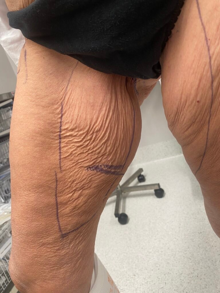 Thigh lift before surgery 3