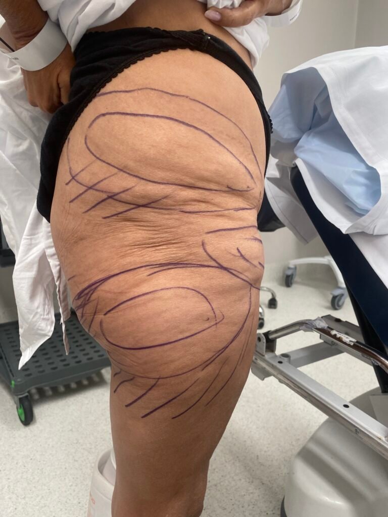 Thigh lift before surgery 5
