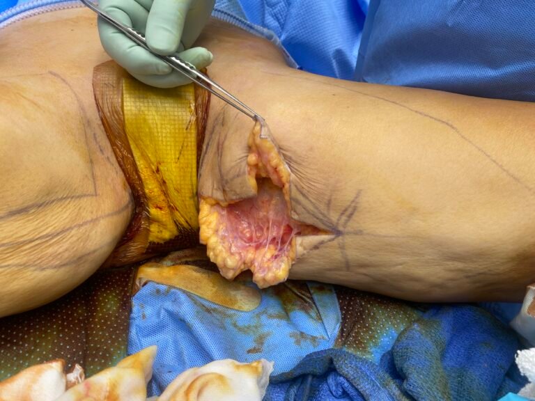 Thigh lift surgery 1
