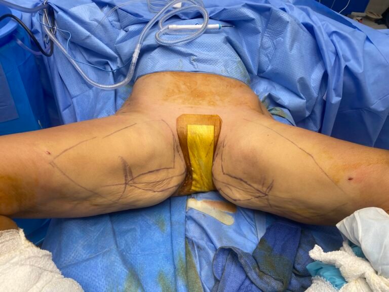 Thigh lift surgery 2