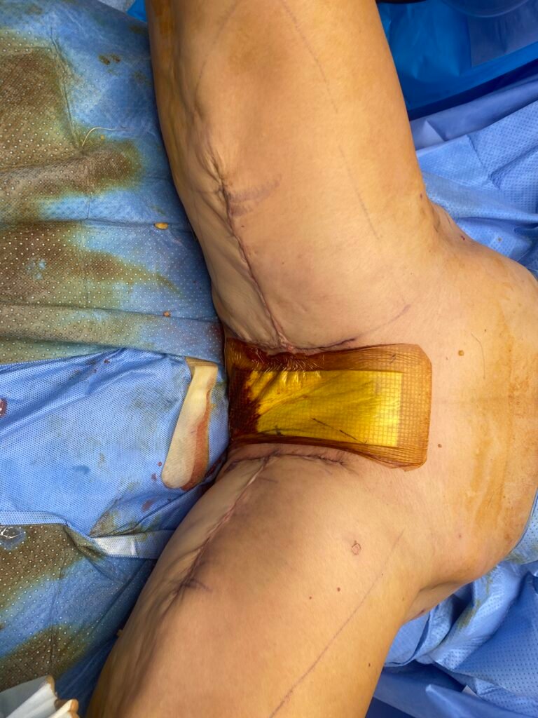 Thigh lift surgery 3