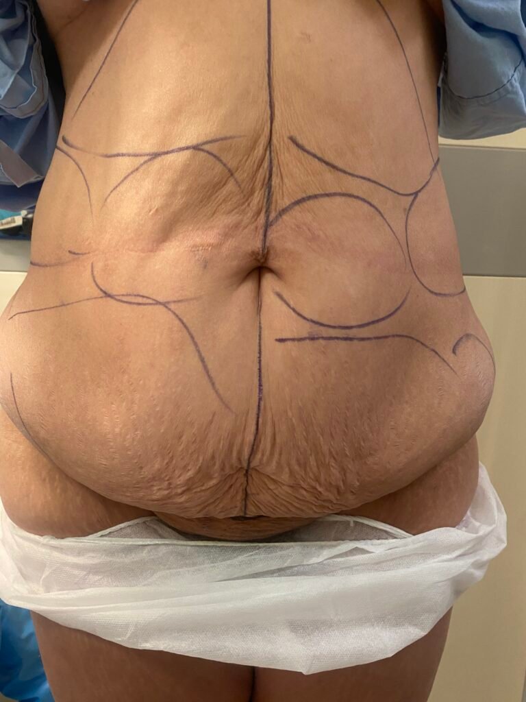Tummy Tuck B1