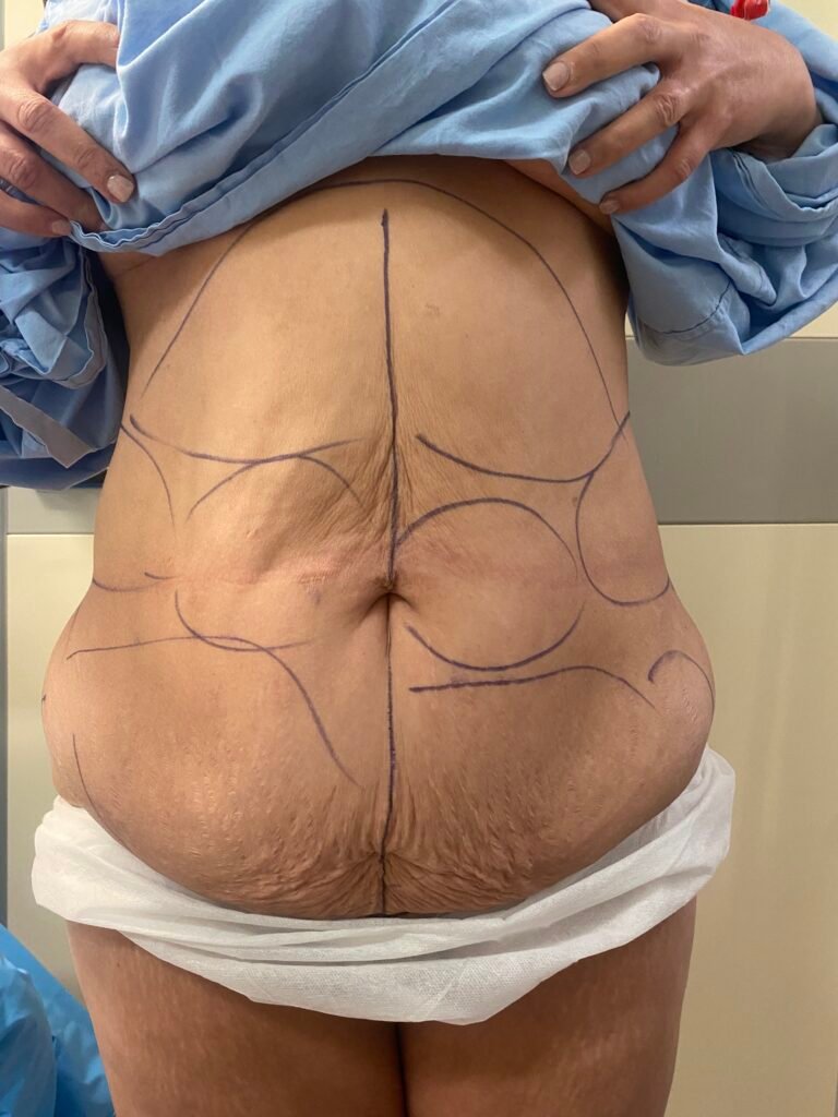 Tummy Tuck B2