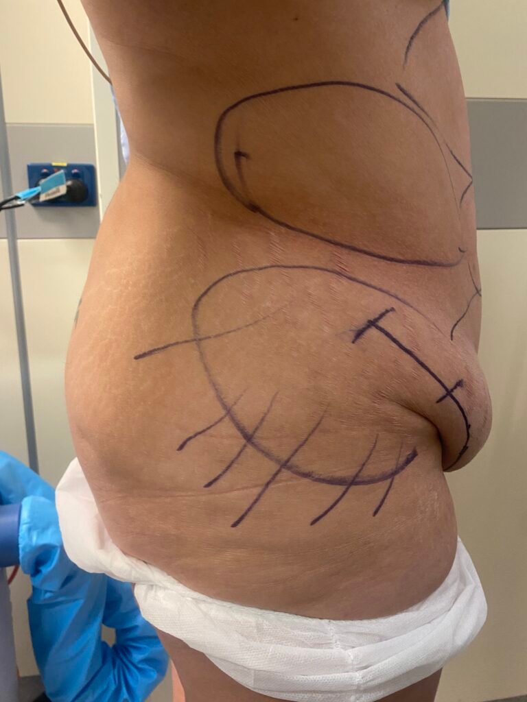 Tummy Tuck B3