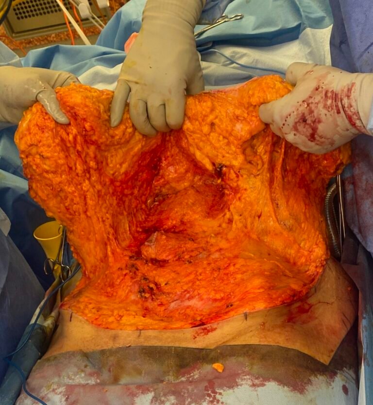 Tummy Tuck B4