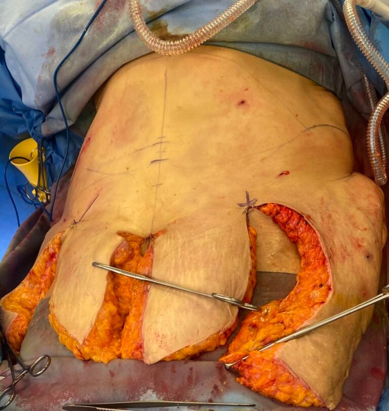 Tummy Tuck B5