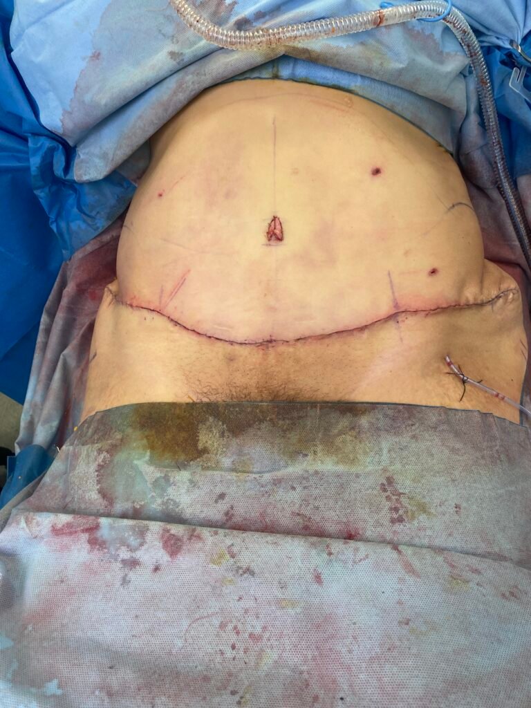 Tummy Tuck B6