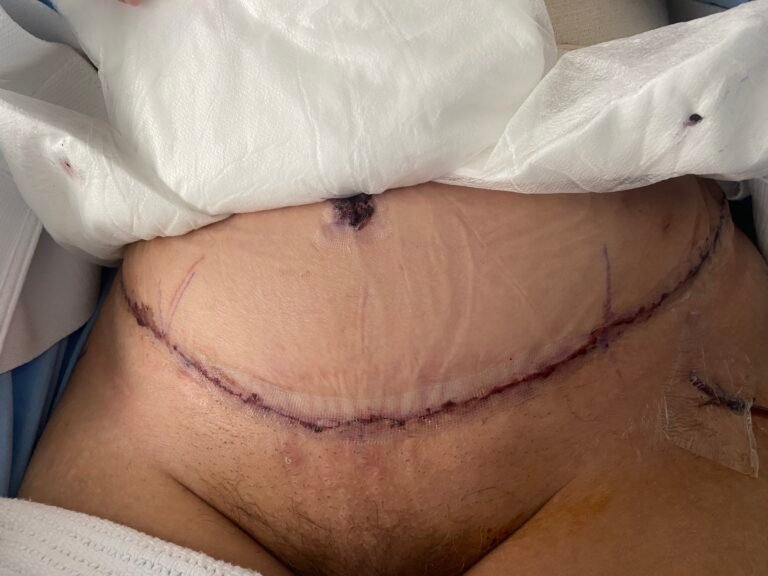 Tummy Tuck B7
